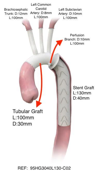 Stent Graft and Tubular Graft